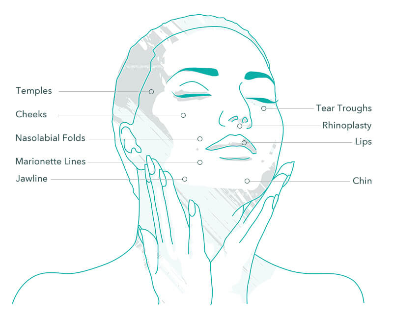 Dermal Fillers treatment areas