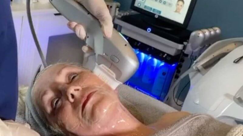 HOFI non surgical facelift treatment