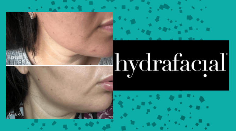 hydrafacial microneedling