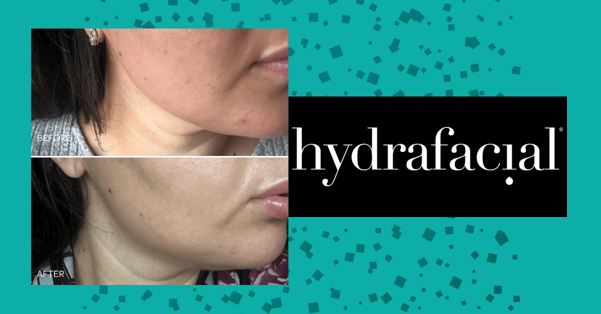 Hydrafacial or Microneedling with mesotherapy?