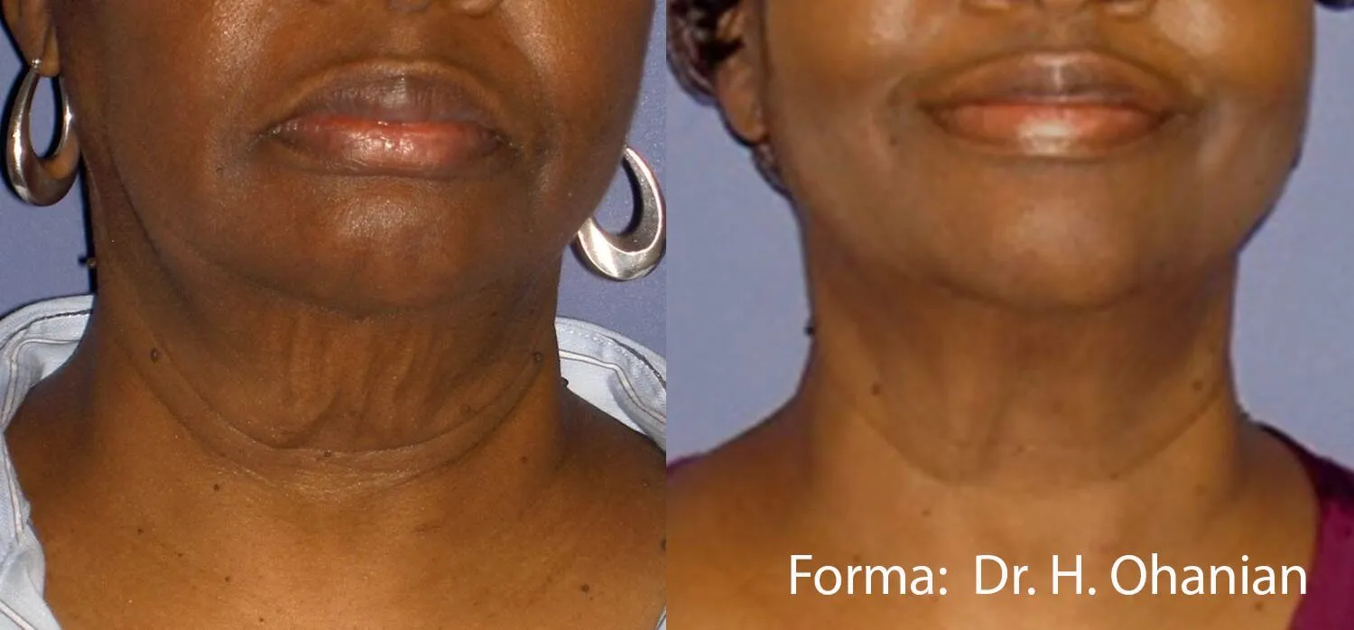 Forma – Radiofrequency Skin Tightening