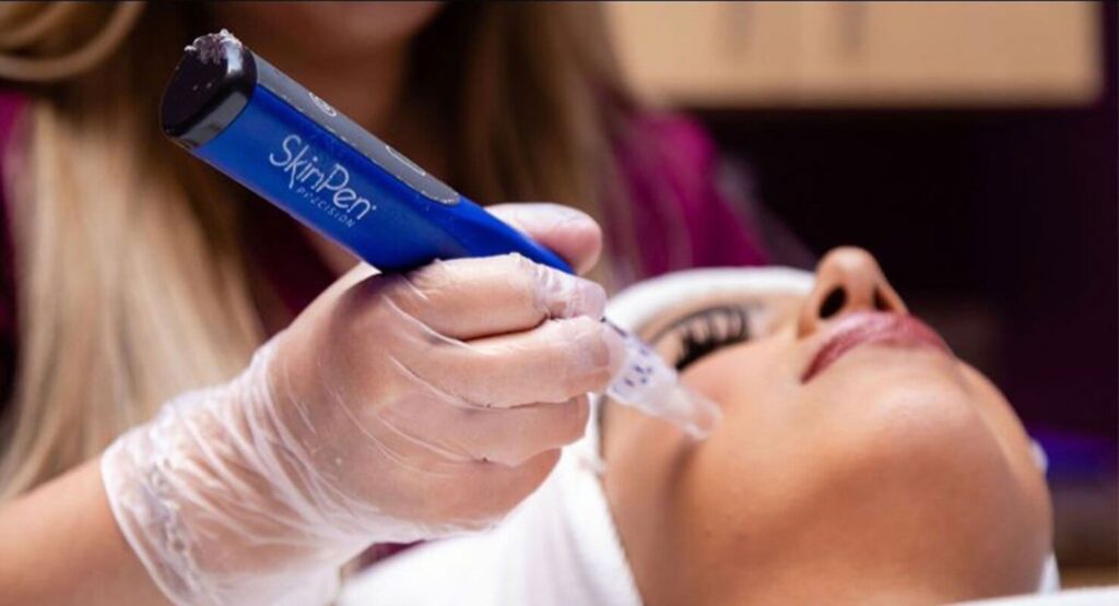 SkinPen Microneedling